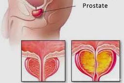 prostat
