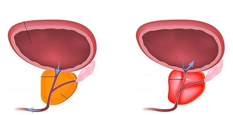 Prostatit ile sağlıklı ve iltihaplı prostat
